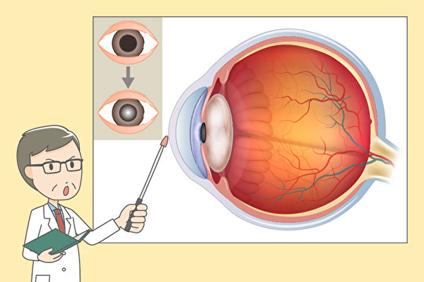 白內障是造成失明的第一原因，中醫怎樣治療和保養？